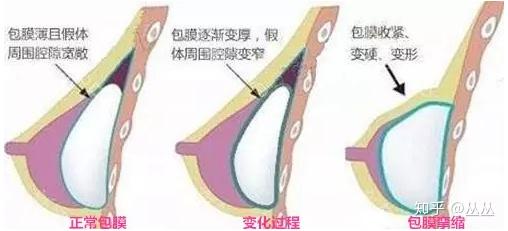 隆胸打针隆胸打针，现代女性的美丽秘诀-第1张图片