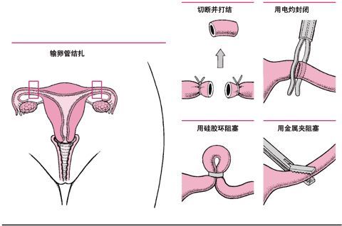 儿子知道妈妈结扎了每天都要吃药吗儿子如何面对母亲结扎后的日常-第1张图片
