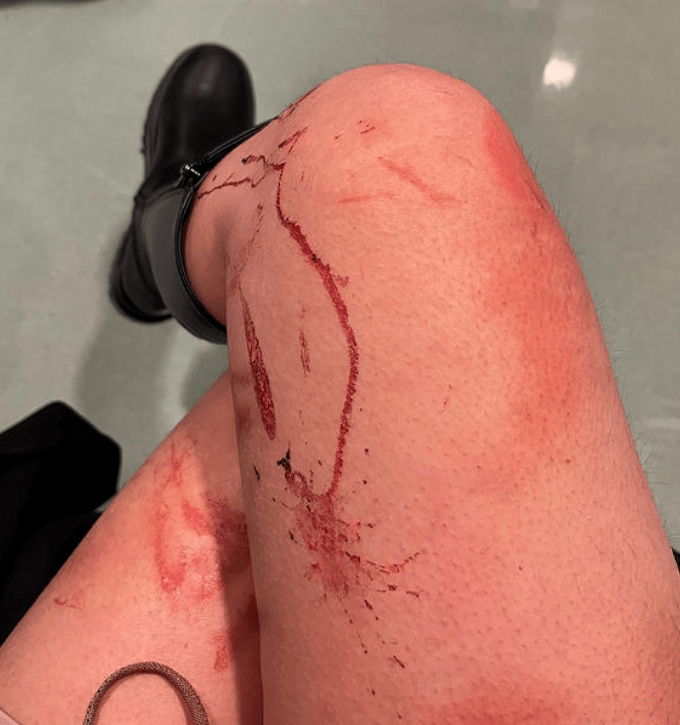 真实血淋淋处破女流血真实背后的残酷——血淋淋的伤口与女子的流血