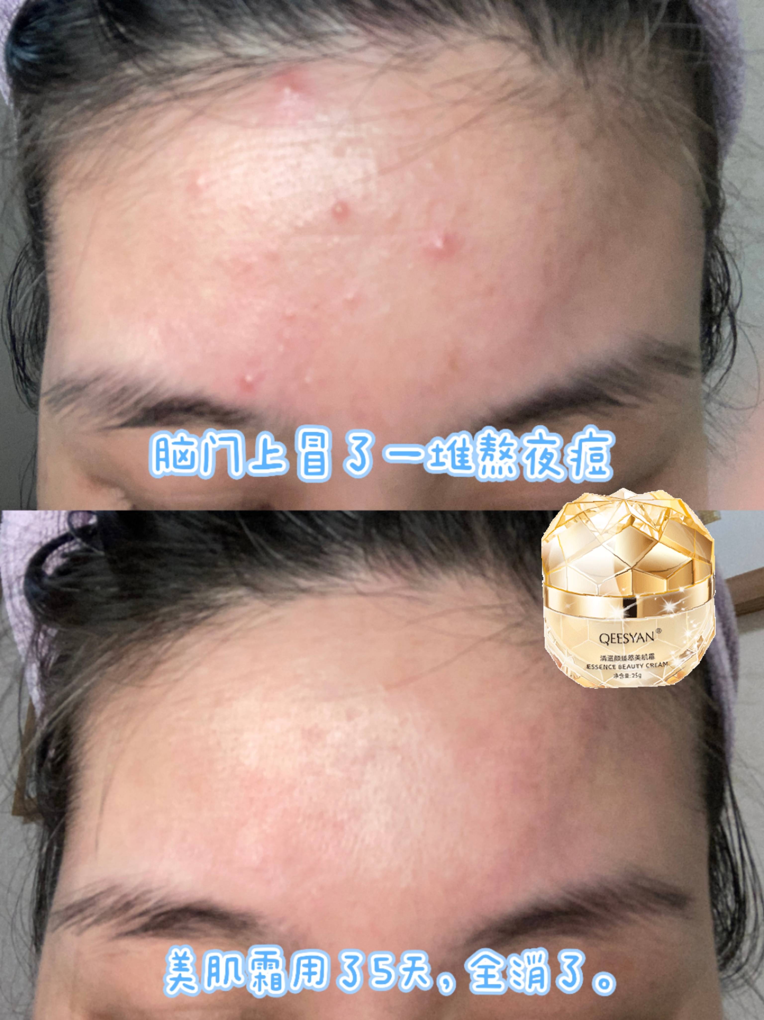 怎样揉自己的痘痘揉到腿软正确揉搓痘痘，避免过度刺激——如何让肌肤恢复健康，避免腿软-第2张图片