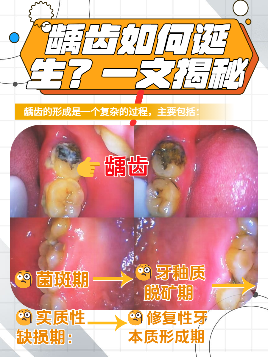 虫牙真的是牙齿里有虫吗蚂蚁庄园虫牙之谜，牙齿里真的藏有虫吗？——揭秘蚂蚁庄园的口腔健康常识-第2张图片