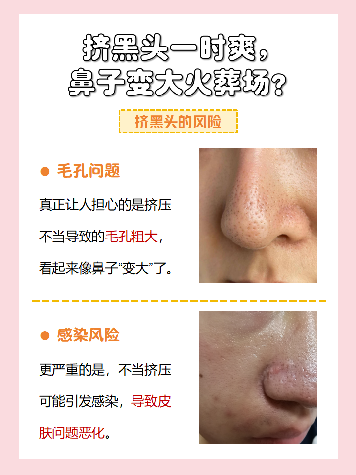 粗大黑头紫大黑头紫挤进粗大黑头紫，一次不寻常的肌肤问题探索与处理经历-第2张图片