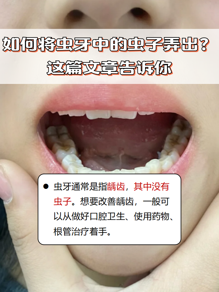 虫牙是真有虫子吗虫牙真的是牙齿有虫吗？——揭秘蚂蚁庄园的口腔健康知识-第1张图片