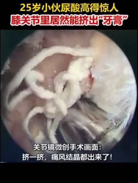 胡桃与尿道口异常现象，白色液体的秘密