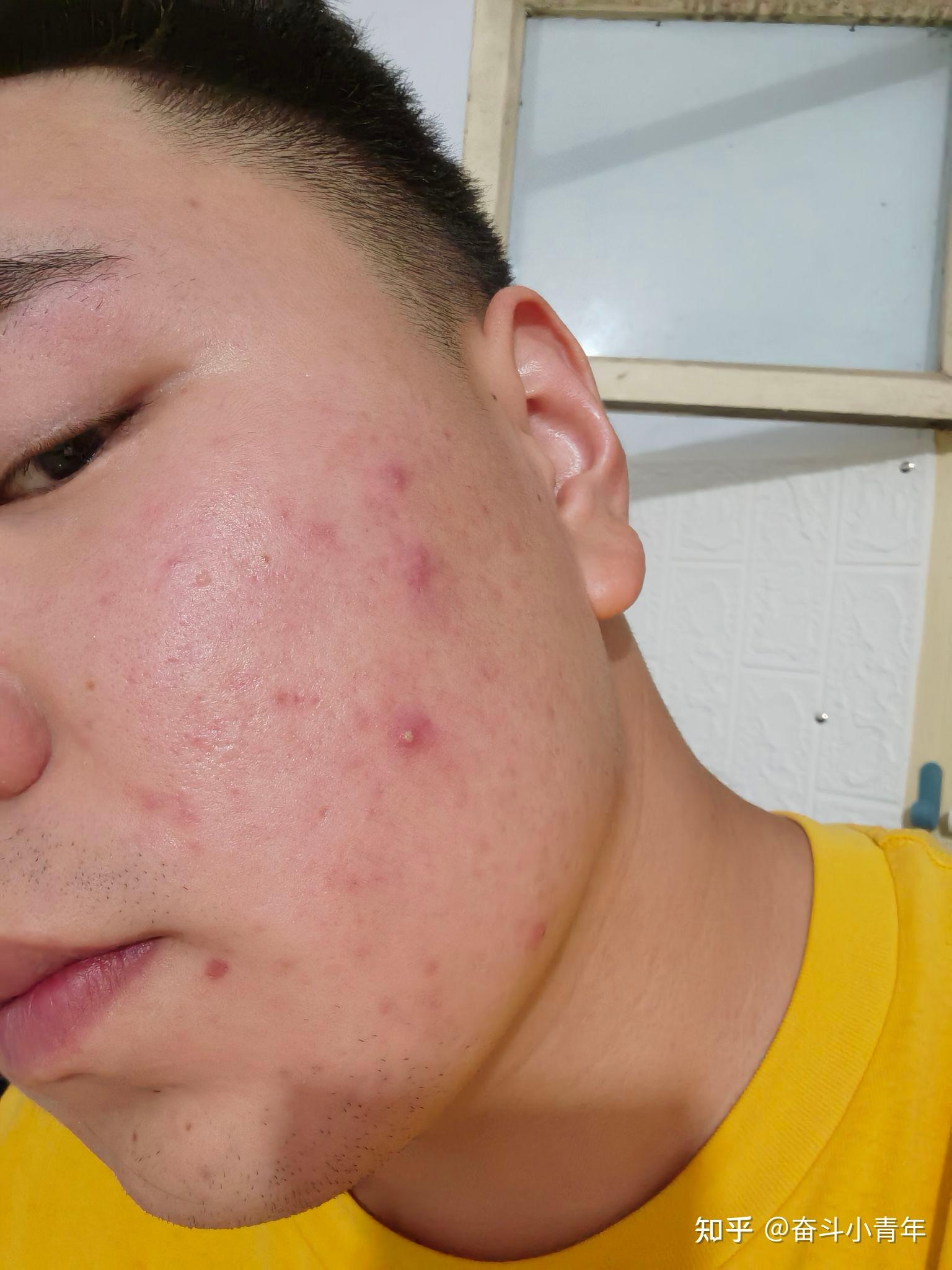 男朋友吃自己的痘痘的感觉关于男朋友吃自己痘痘的体验