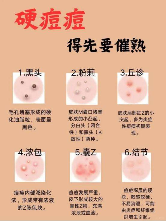 怎样弄小痘痘才会浑身酥软如何正确处理小痘痘，让肌肤恢复光滑，浑身感觉酥软-第2张图片