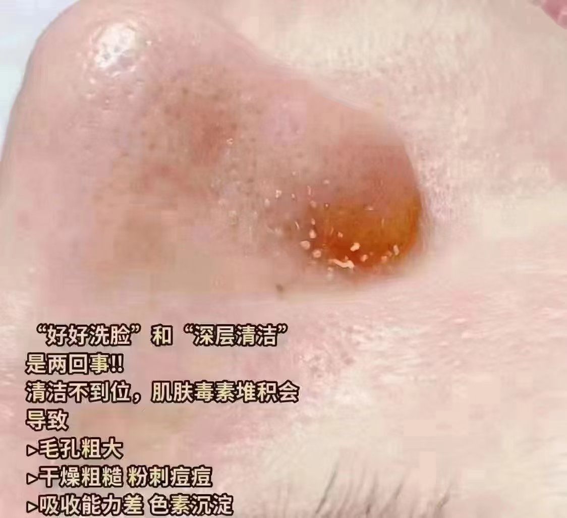 粗大黑头紫大黑头紫挤进粗大黑头紫，一次不寻常的肌肤问题探索与处理经历-第1张图片