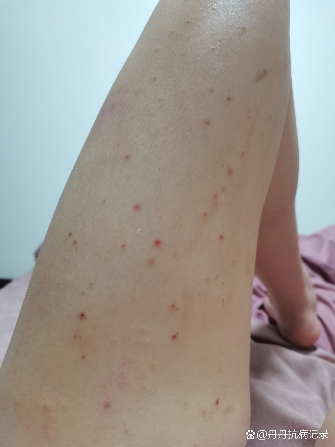 二腿间搔痒淑芳的私密困扰，两腿间痒的50次经历-第2张图片
